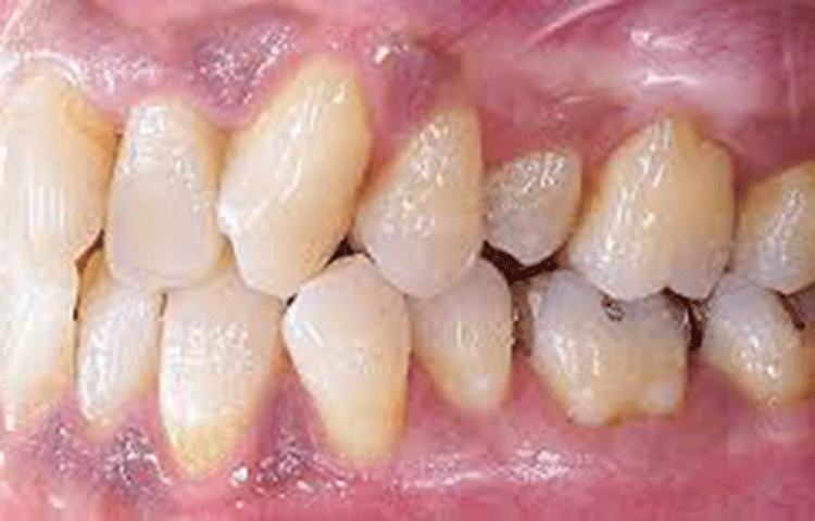 日本人が歯を失う原因の1位は歯周病です